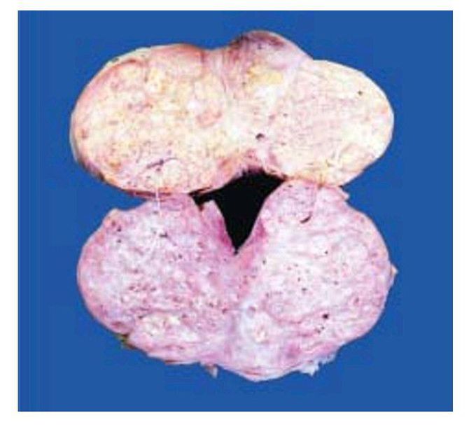 Nodular enlargement of the prostate.