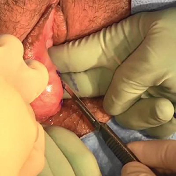 Bartholin's Cyst