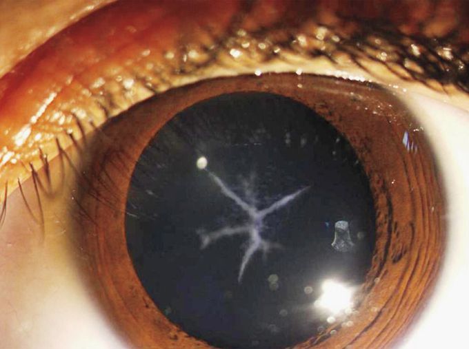 Congenital Sutural Cataract