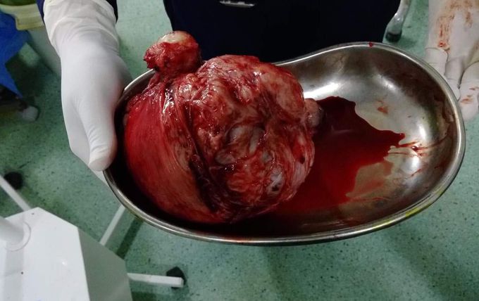 Tumor of uterus