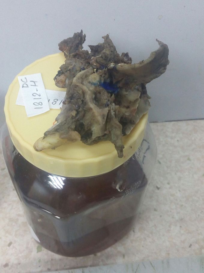 Surgical removal of mandible bone  (oral cancer)