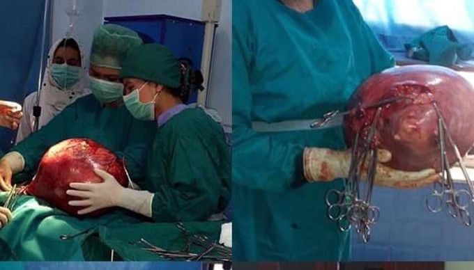 Afghan doctors successfully removed tumor (21kg) from stomach of a patient in Ghazni province. #Afghanistan