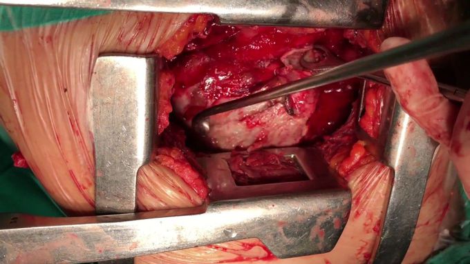 Decortication - Lung