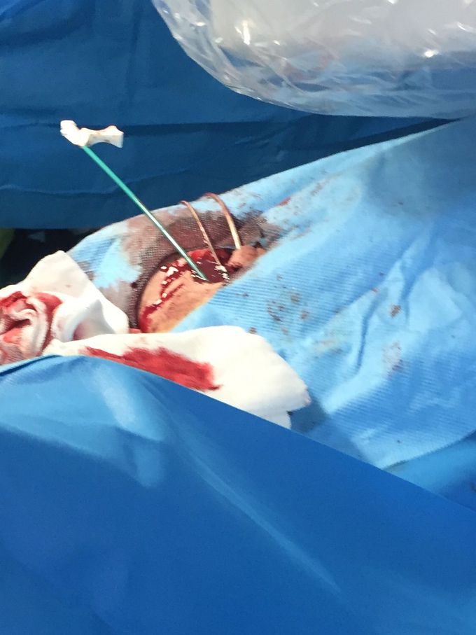 ICD implant