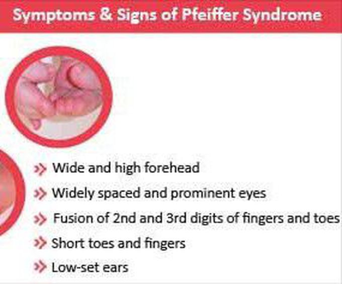 These are the symptoms and signs of Pfeiffer syndrome
