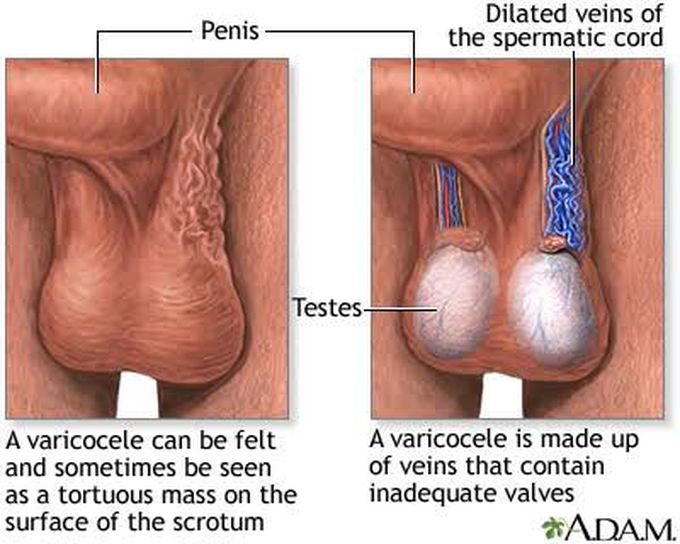 Symptoms of varicocele
