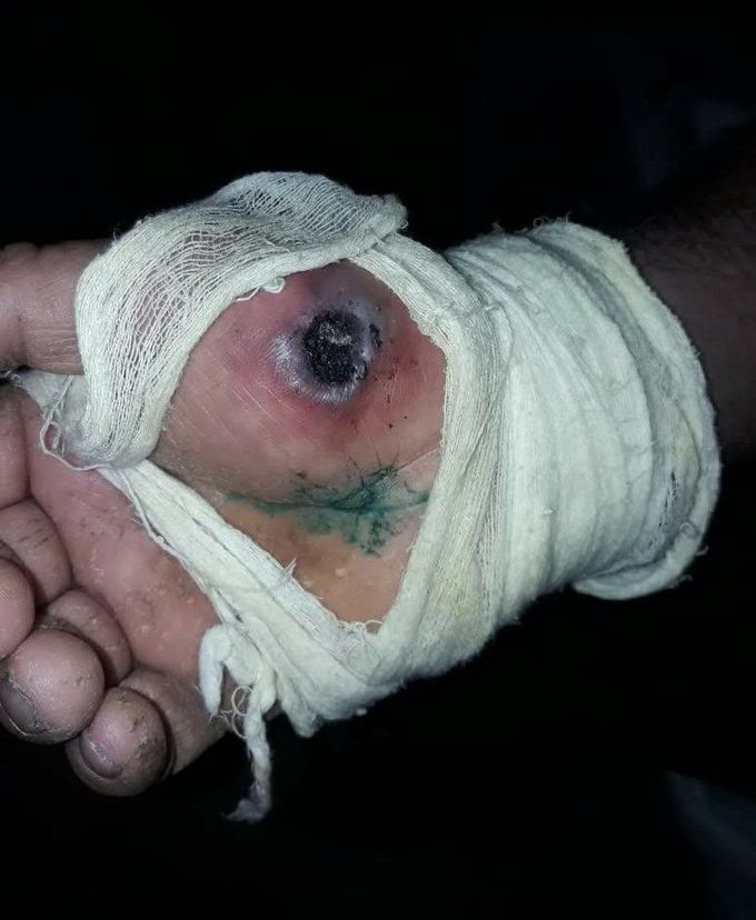 Anthrax is a rare but serious illness caused by a spore-forming bacterium, Bacillus anthracis. Anthrax mainly affects livestock and wild game. Humans can become infected through direct or indirect contact with sick animals