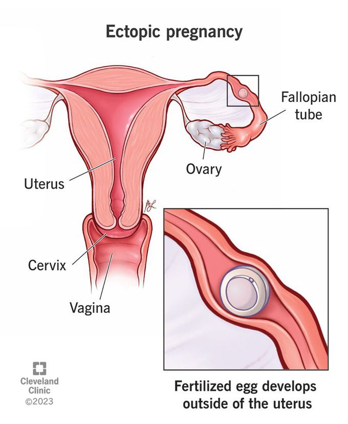 symptoms of an ectopic pregnancy