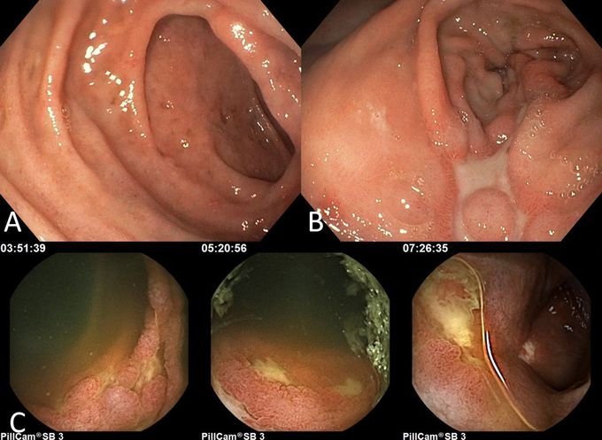 Mesenteric ischemia