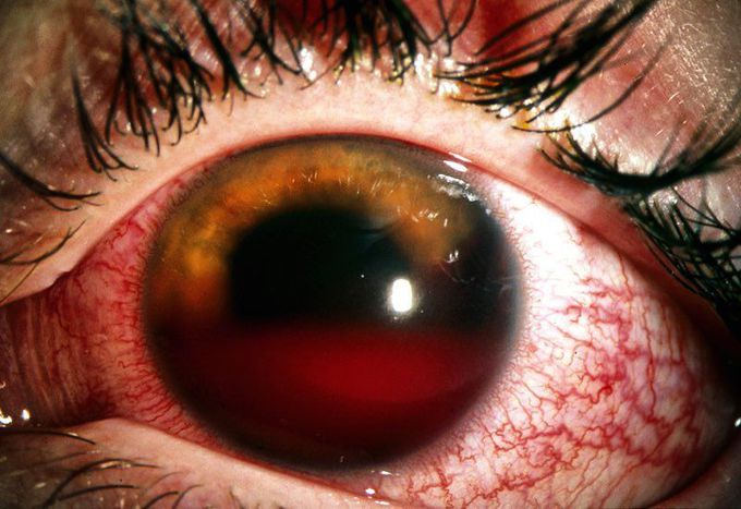 We call it hyphema!