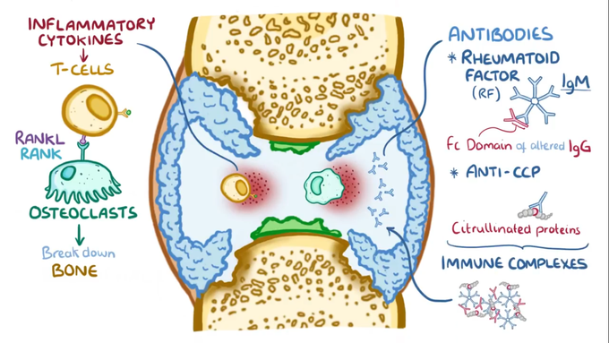 Rheumatoid arthritis - MEDizzy