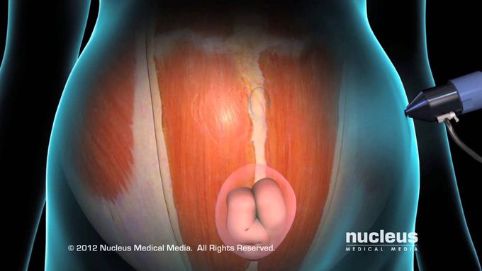 Laparoscopic Hernia Repair: Ventral and Incisional