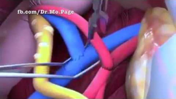 Renal Transplantation Procedure