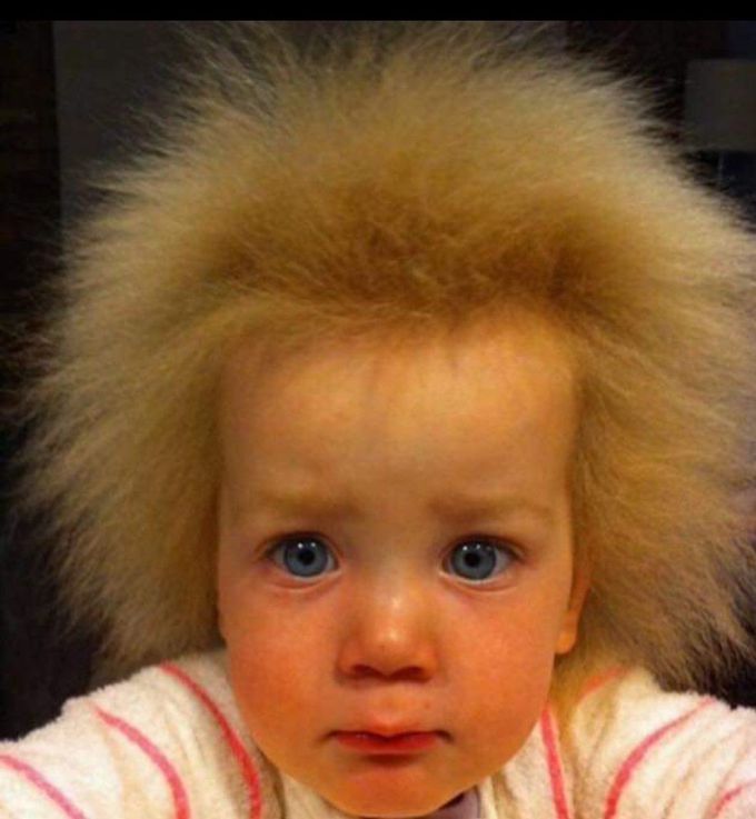 Uncombable hair syndrome..