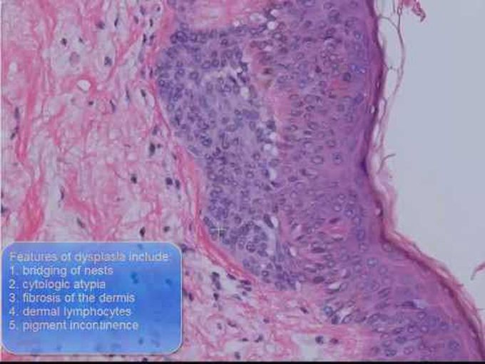 Introduction to Melanocytic Lesions.
