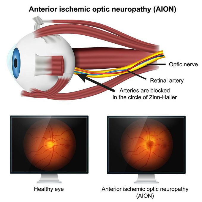 Optic neuritis treatment