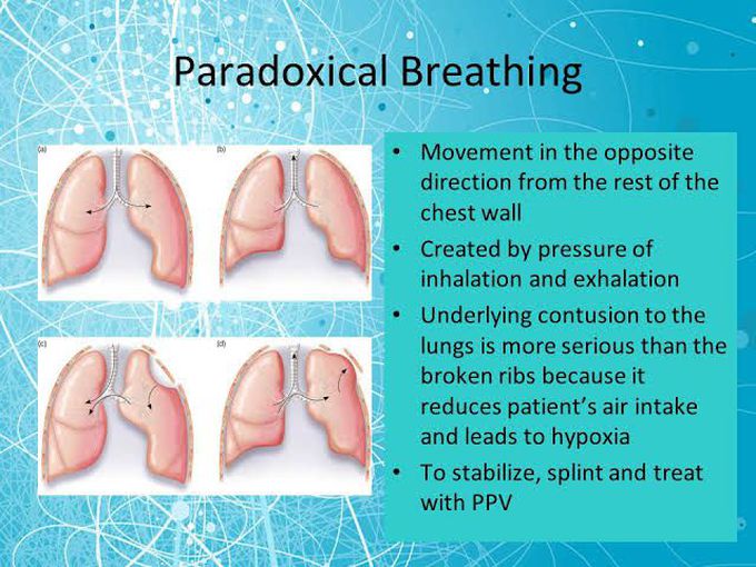 Paradoxical breathing