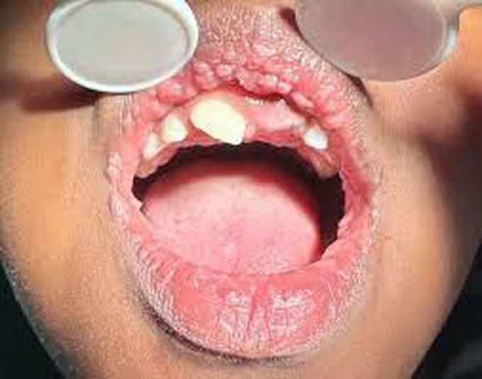 Hecks disease