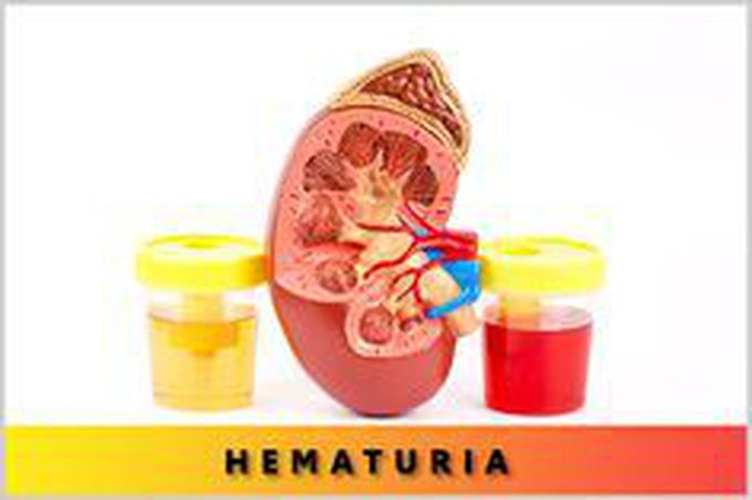 Hematuria