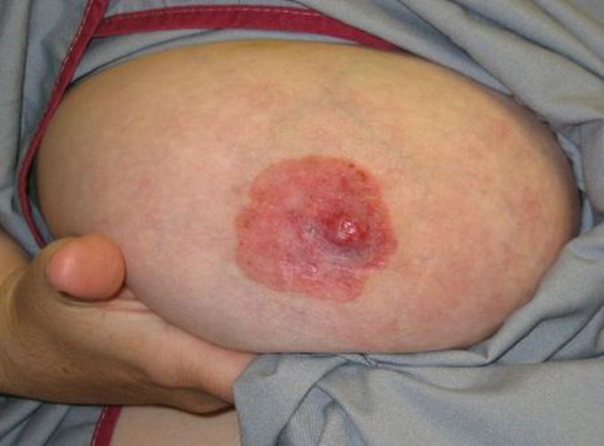 What is the diagnosis ?