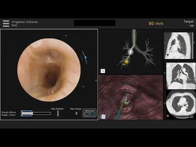 Robotic-Assisted Bronchoscopy to Evaluate a Solitary Peripheral Lung Nodule