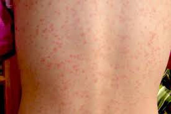 Treatment of scarlet fever