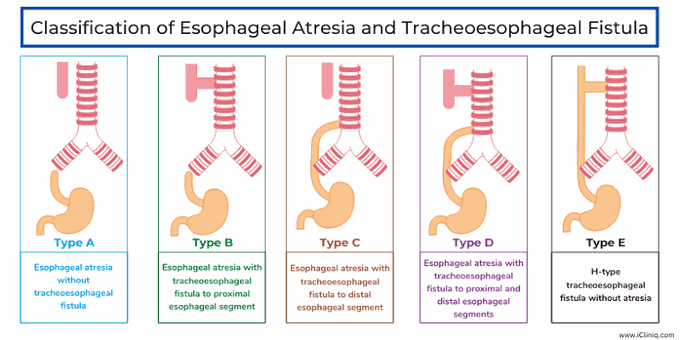 Classification of Esophageal atresia and tracheoesophageal fistula