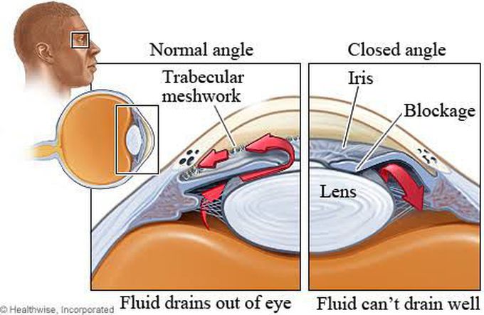 Angle closure glaucoma