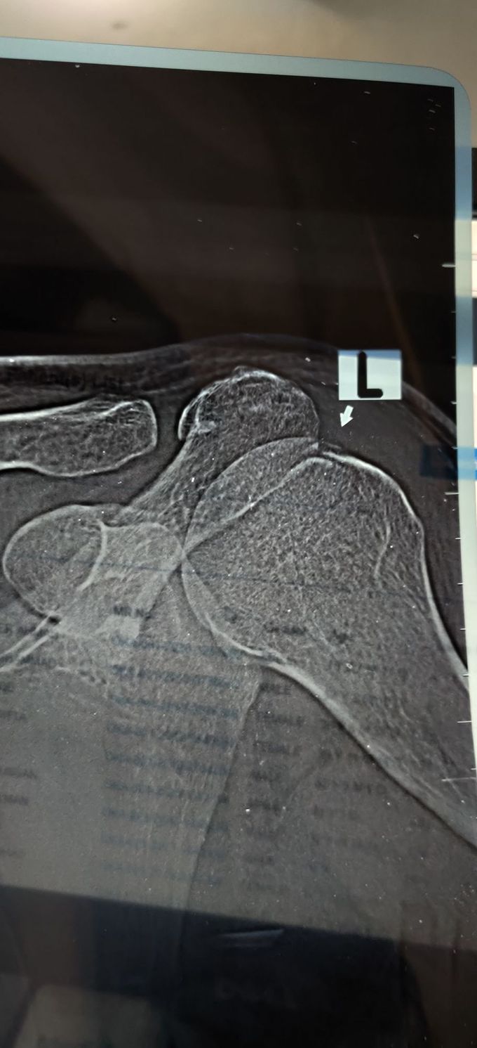 Humerus Fracture / Ligament Avulsion