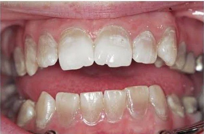 Dentinogenesis imperfecta