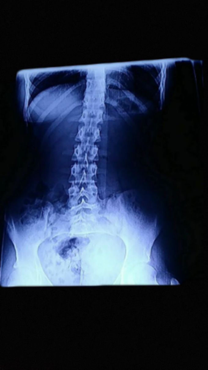 X-ray of chest and abdomen