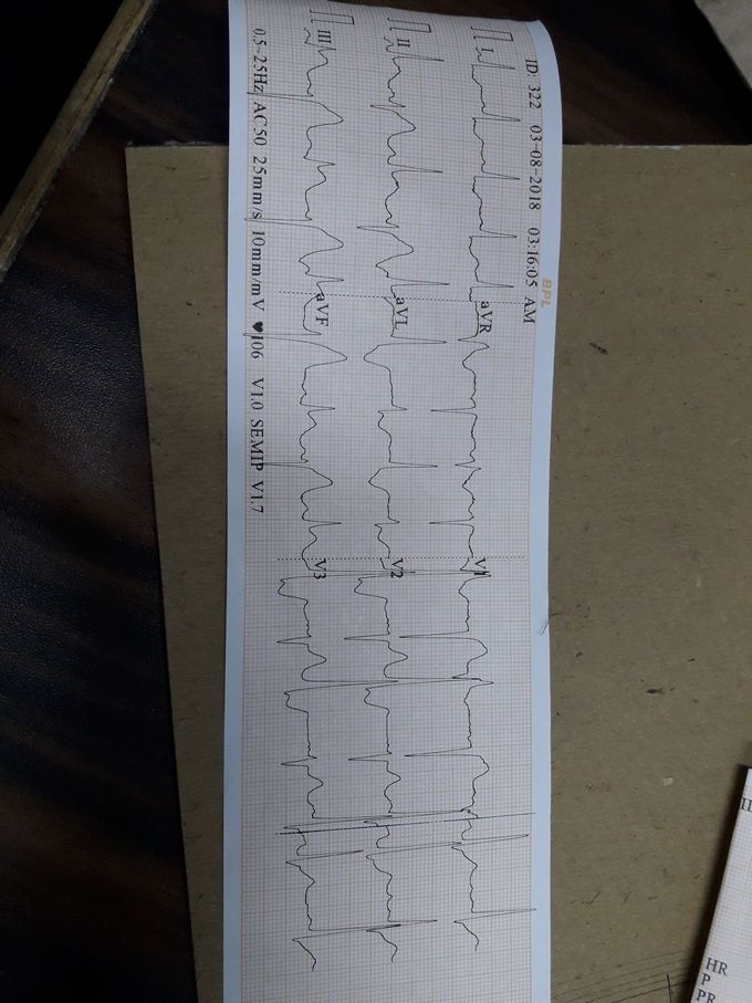 What is problem in this ECG and explain