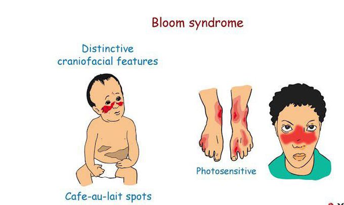 Bloom syndrome