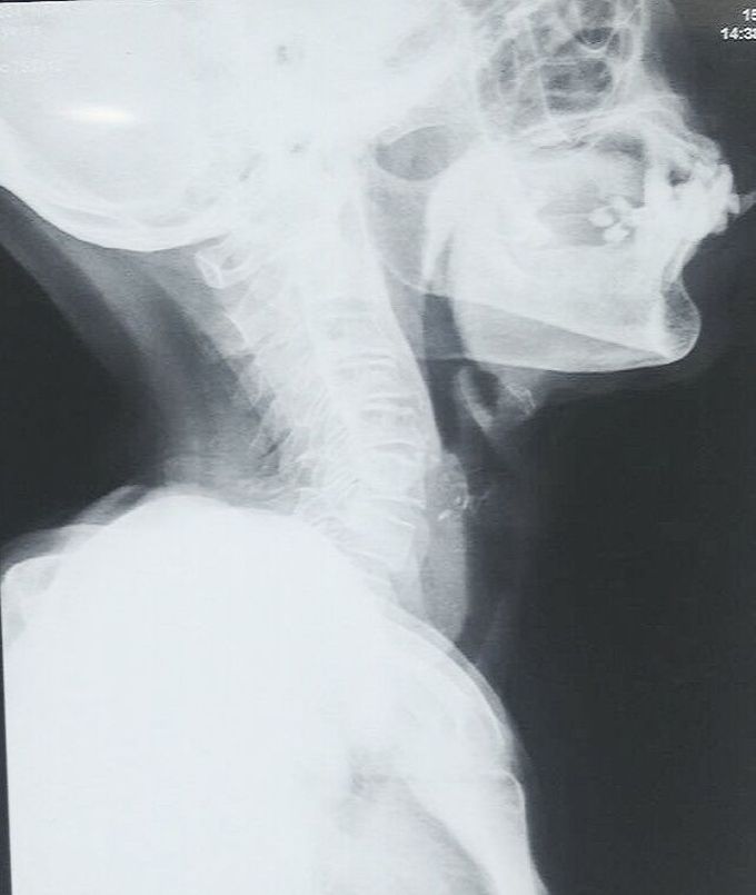 Xray neck lateral view