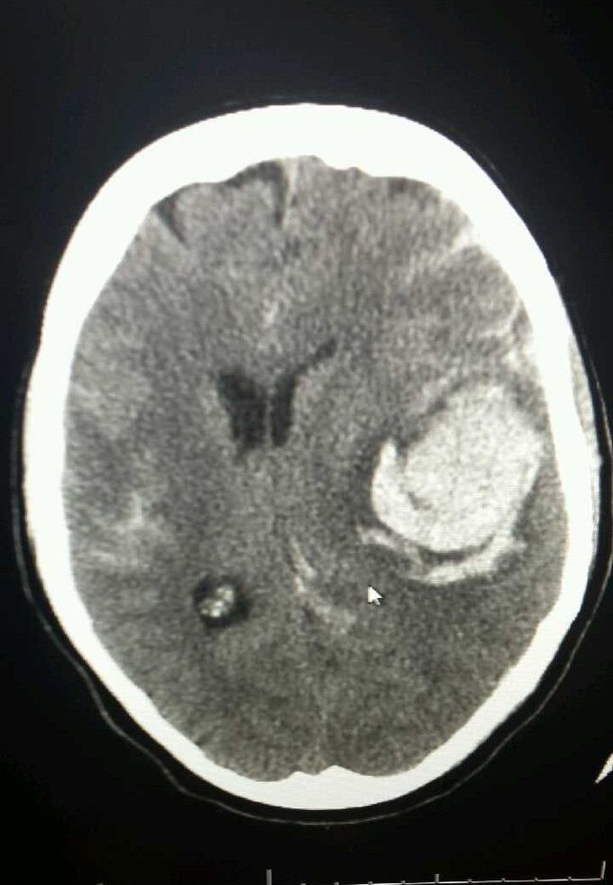 Neurosurgery