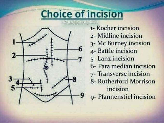 Incision
