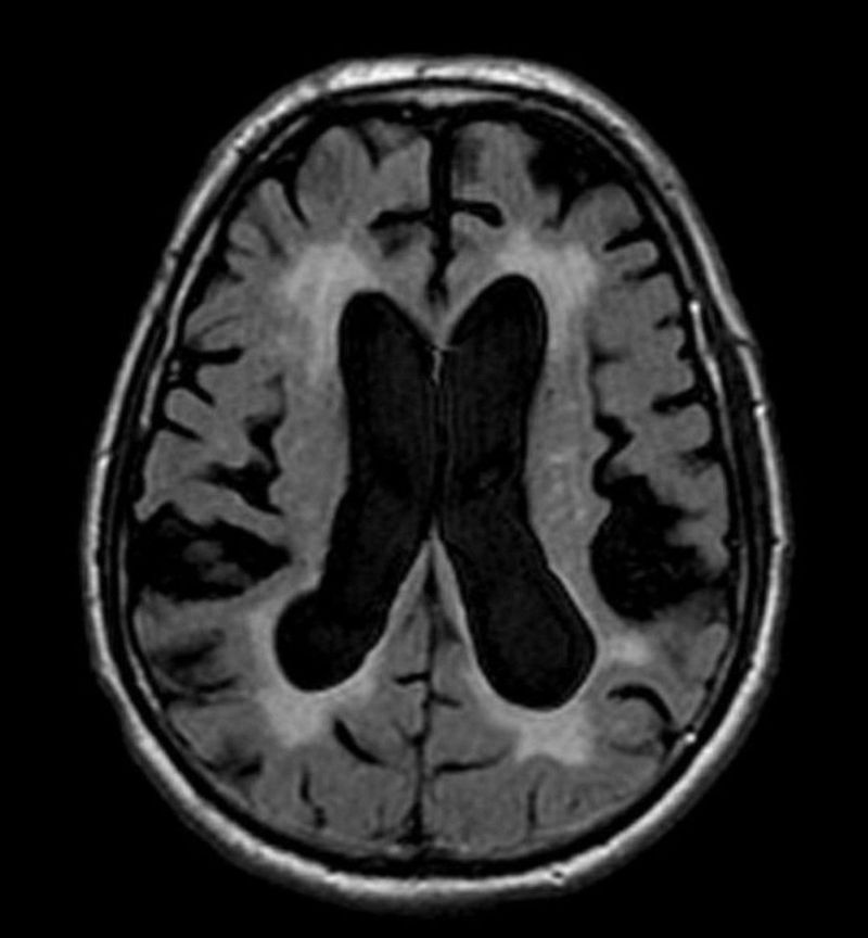 Normal Pressure Hydrocephalus Psychiatric Symptoms