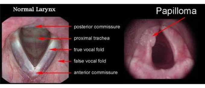 Treatment for respiratory papillomatosis