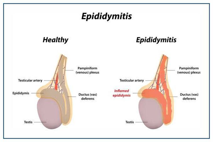 Symptoms of epididymitis
