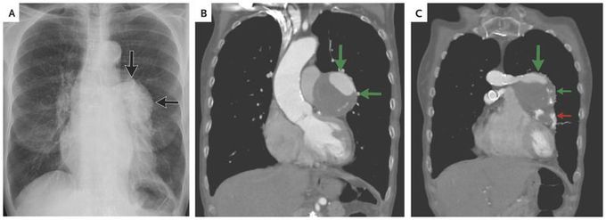 Aortocoronary Saphenous-Vein–Graft Aneurysms