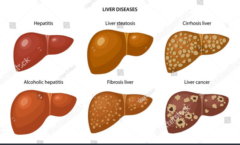 Liver Diseases Medizzy