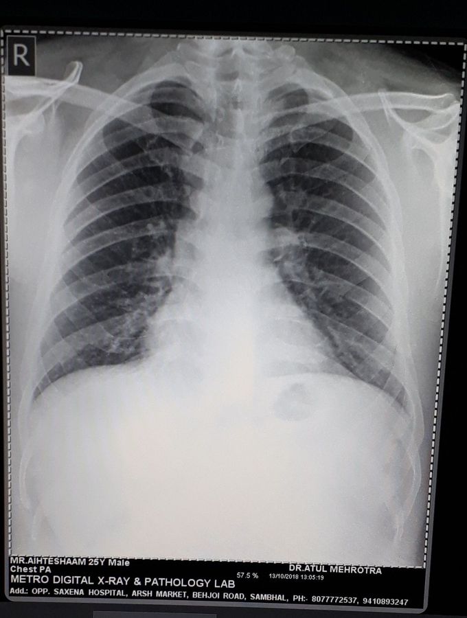 Diagnose the CXR