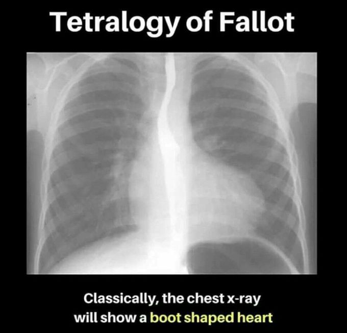 Fallot tetralogy