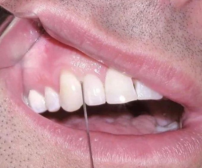 Intraligamentary Anesthesia