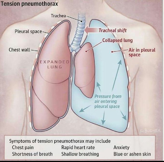 Tension Pneumothorax