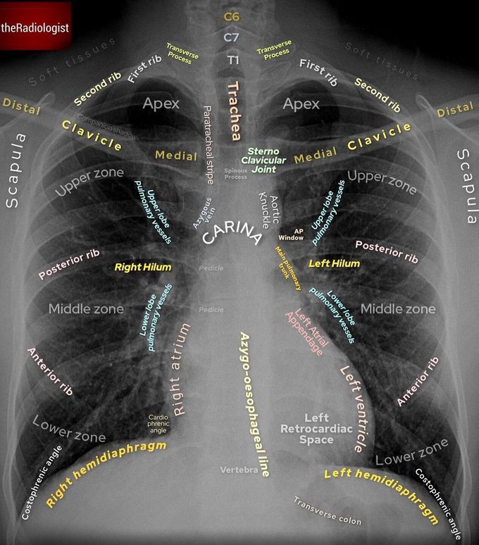 Chest X-ray Anatomy