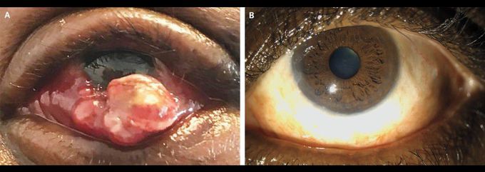 Conjunctival Kaposi’s Sarcoma