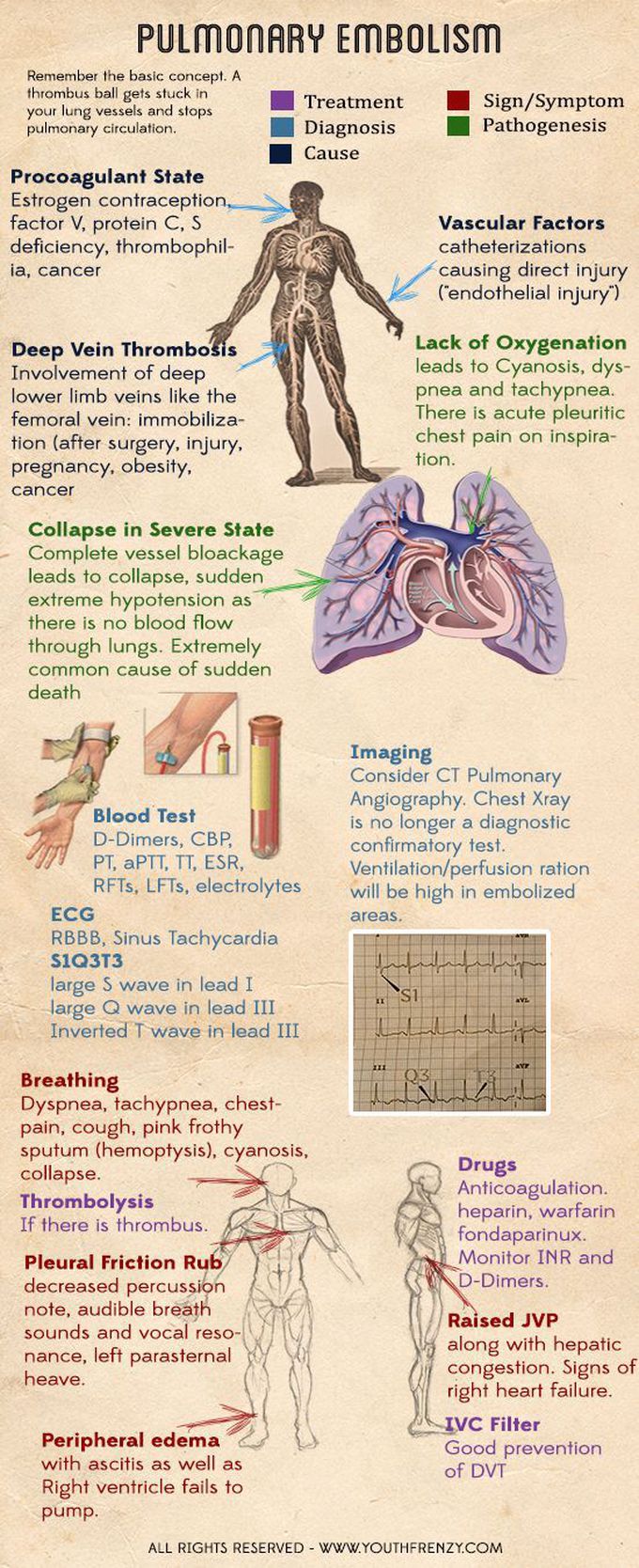 Pulmonary embolism