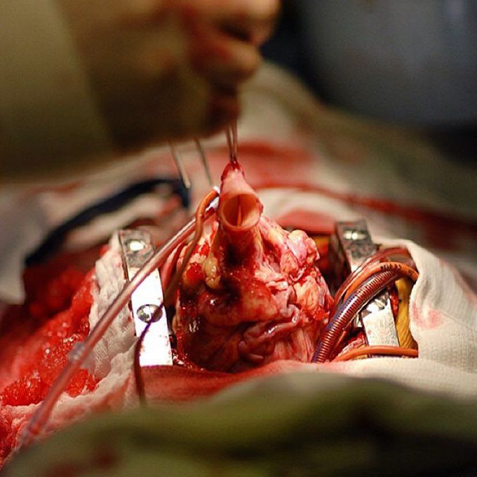 A 9-year-old pediatric patient getting a new heart