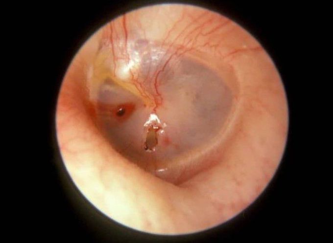 Ruptured eardrum